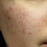 [댓글부탁해] 혐주의) 나 피부 이정도면 좋아진거 아닐까..?