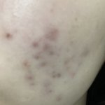 (혐주의) 노스카나 <b>두</b> <b>달</b> 후기