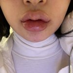 입술<b>필러</b><b>맞음</b>