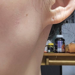 [제발읽어줘] 사각턱이라고 턱보톡스 잘못 맞으면 큰일난다...