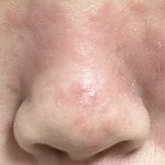 [이것좀봐줘] 일소코팩 부작용 (사진주의)