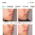 <b>돌출</b>입 수술이거 잘아는분
