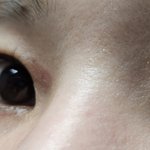 피부과 시술후 <b>화상</b>입은 경우 어떻게 하나요?