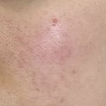 [댓글부탁해] 이거는 여드름임 여드름<b>흉터</b>임?