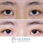 앞트임 <b>복원</b>수술할까