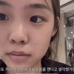 이 사람 코<b>수술</b> 개잘되지 않았냐