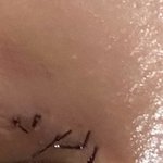 나심심해서 쌍수<b>실밥</b> 셀프로 뽑았는데