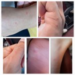 제주도 호텔에서 빈대인지 <b>벼룩</b>인지 물렸어요ㅠ