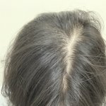 고2여자인데 <b>탈모</b>인가요?