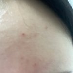 [댓글부탁해] 여드름쟁이라면 이거 ㅈㅂ 써보셈 ;;;; (<b>전후사진</b>잇음)
