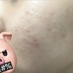 여드름 ㅈㅂ 사진주의