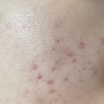 여드름 <b>색소</b>침착(사진잇음!!)