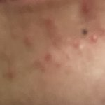 [댓글부탁해] 얘들아 나 피부 ㅠㅠㅠ (혐주의)