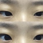 나 <b>쌍수</b>하면 어떨 것 같음? (사진 있어)