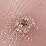 [<b>사마귀</b>] 이거 <b>사마귀</b> 맞아요?