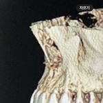 [댓글부탁해] 교정인들아 이거 <b>잇몸</b>돌출임 <b>이빨</b>돌출임..?