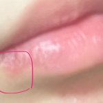 [댓글부탁해] <b>입가</b>에 이거 여드름 맞아?