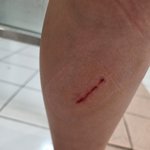 <b>롤러</b>스케이트장 침핀 사고, 개인과실인가요?