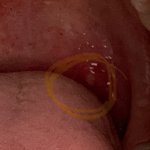 [댓글부탁해] 혐주의) 이거 <b>편도</b>결석임.?