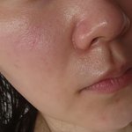 [모두드루와] 안면홍조로 300이상 태워보고 개선함 홍조 심한사람...