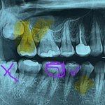 사랑니 <b>발치</b>후 이가 금이갔어요
