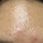 좁쌀여드름 <b>박멸</b>법 제발ㅜㅜ