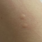 [댓글부탁해] 이거 <b>모기</b>물린거임.????