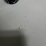 편도결석 역대급 박멸 (혐주의