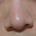 [댓글부탁해] 나 블랙<b>헤드</b> 많이 심함?