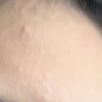 이마 <b>좁쌀</b> 여드름 제발 어케 없앰