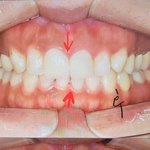 [댓글부탁해] 치아교정 후 중앙라인이 안맞아..