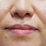 팔자<b>주름</b> 필러 받지마세요