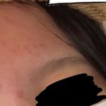 약혐) 피부 안 좋은 얘들아 들어와바 ㄹㅇ 꿀팁