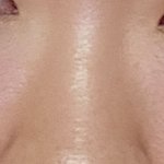 나 콧볼축소할까?