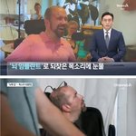 [모두드루와] <b>뇌</b> 임플란트 <b>수술</b> 근황