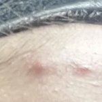 개<b>딱딱</b>하고 개아픈 여드름 남