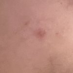 <b>바늘</b> 여드름패치 붙엿는데 흉터생김