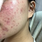 17살 여자 <b>피부고민</b>ㅜㅜㅜㅜㅜ제발봐즈세요