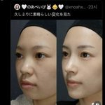 <b>돌출</b>입 교정하면 ㄹㅇ 일케 변하는거 ㄱㄴ함?