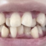 [댓글부탁해] 나 <b>이빨</b> 많이 심각하냐