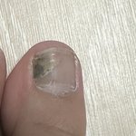 <b>발톱</b> 개잘라냄