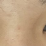 쌍꺼풀