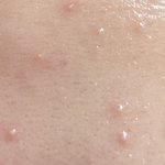 <b>좁쌀</b>인지 모낭염인지좀 봐줘 혐주의