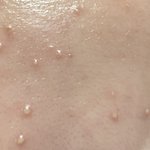 아니 <b>모낭염</b> 잘아는사람 ㅠ