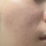 피부 요렇게 됐는데 뭐 발라야함 ㅠ