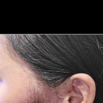 교정기로 턱인대가 찢어져서요