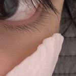 다크<b>서클</b> 주사 맞아본 사람 있음?