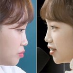 [모두드루와] 합퀴들 <b>윈터</b> <b>코</b>수술가지고 까는거 개웃김