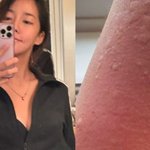 이혼' 중 안타까운 근황..."온몸에 피부발진" [<b>SHOT</b>!]