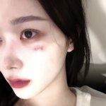 쓰러지면서 생겼던 <b>흉터</b> 많이 좋아진 지젤